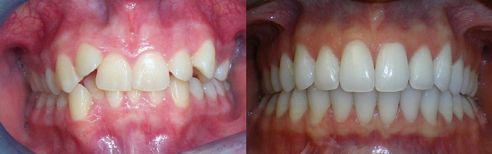 Before and After Crowding Korch Orthodontics in Hershey, PA