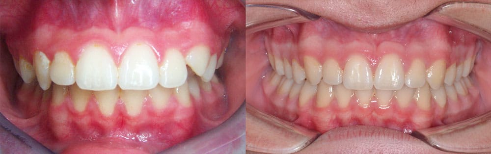 Before and After Excessive Overjet Korch Orthodontics in Hershey, PA