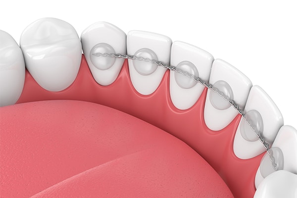 Fixed Retainers Korch Orthodontics in Hershey, PA