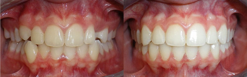 Before and After Impacted Canine Korch Orthodontics in Hershey, PA