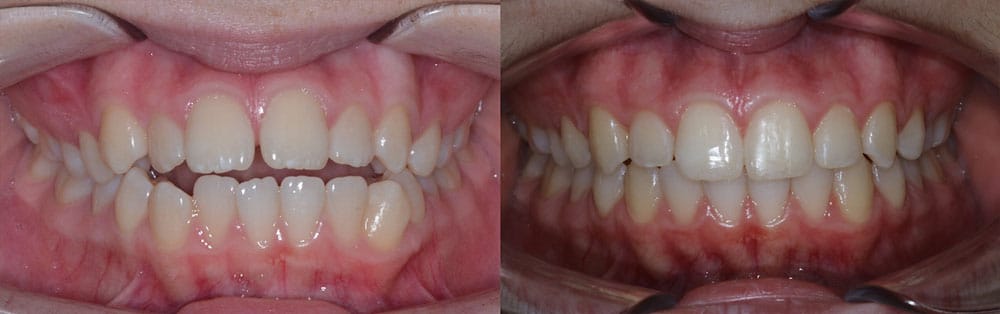 Before and After Open Bite Korch Orthodontics in Hershey, PA