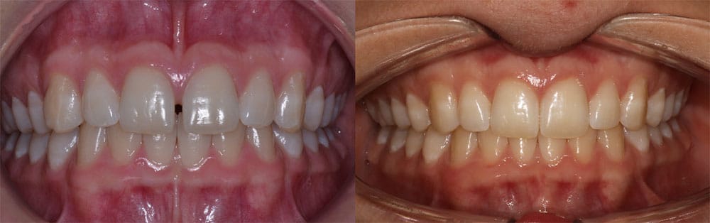 Before and After Spacing Korch Orthodontics in Hershey, PA
